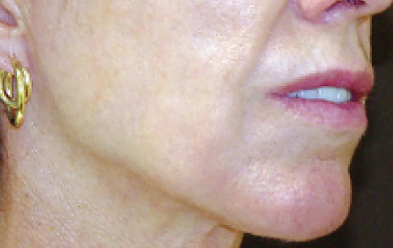 After Thermage treatment example