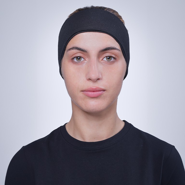 Before Juvederm treatment