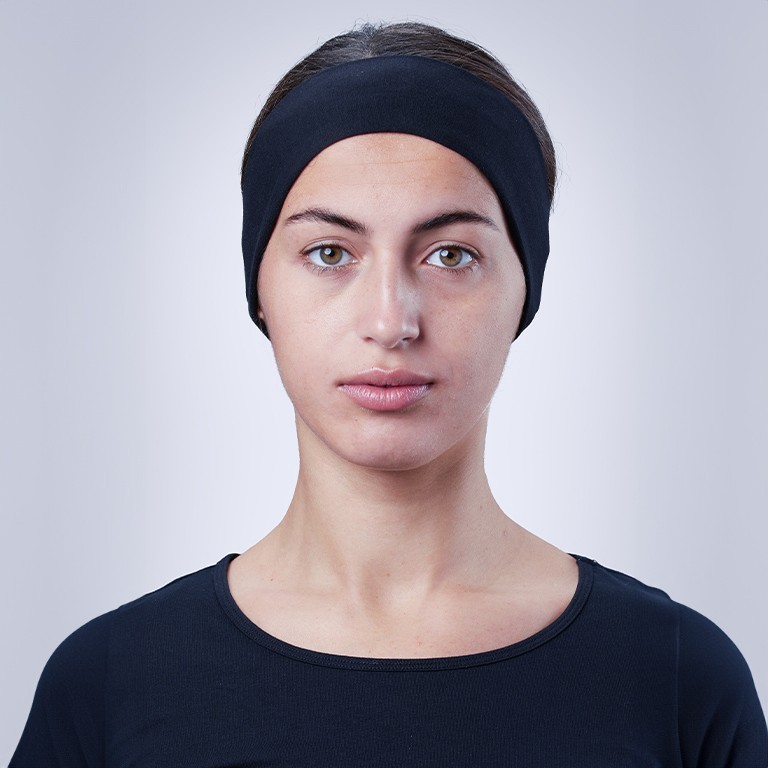 After Juvederm treatment