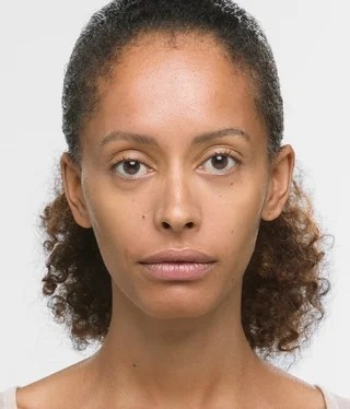 Before Sculptra treatment