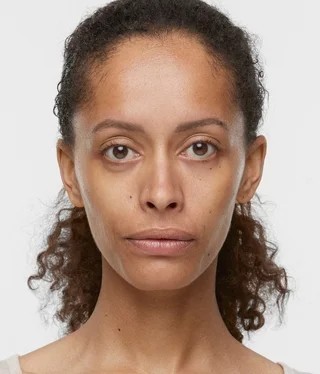 After Sculptra treatment