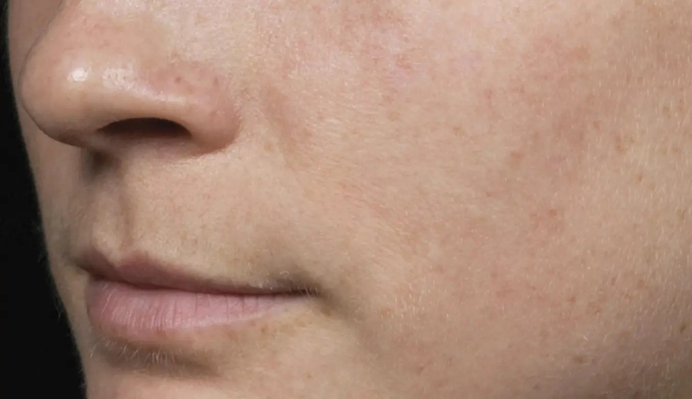 Before Fraxel Laser treatment