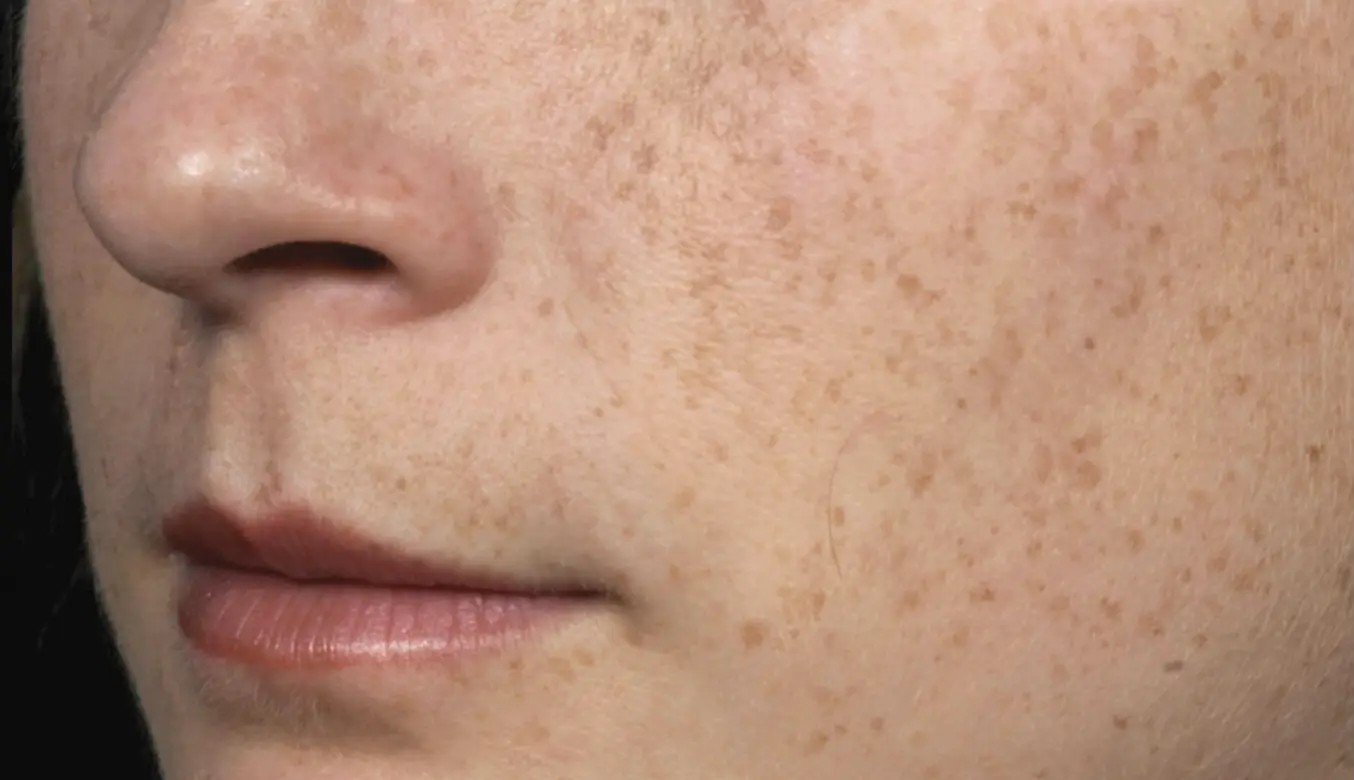 After Fraxel Laser treatment