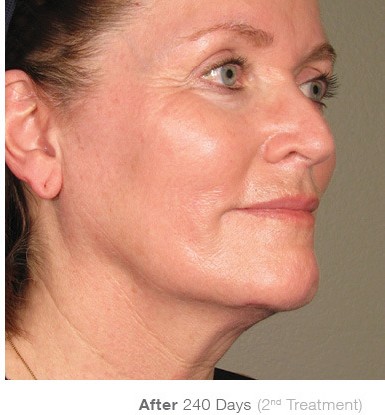 Before Ultherapy treatment