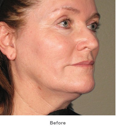 After Ultherapy treatment