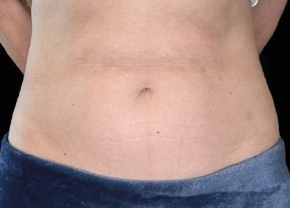 Before Emsculpt Neo treatment