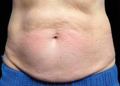 After Emsculpt Neo treatment