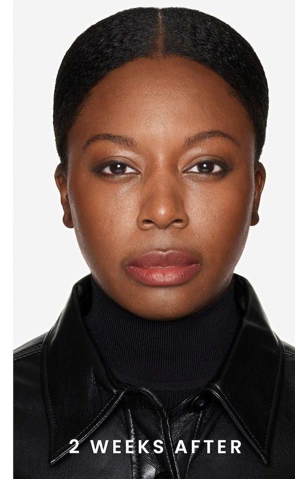 Before Daxxify treatment