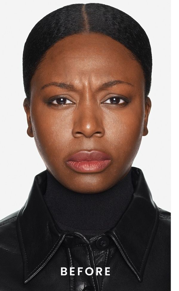 After Daxxify treatment