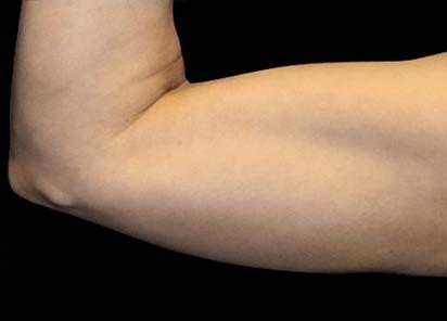 Before Emsculpt treatment