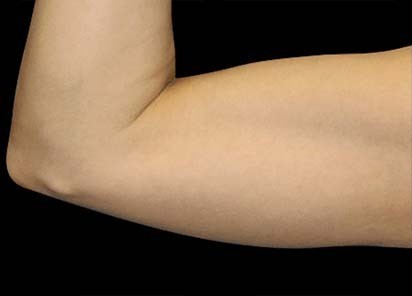 After Emsculpt treatment